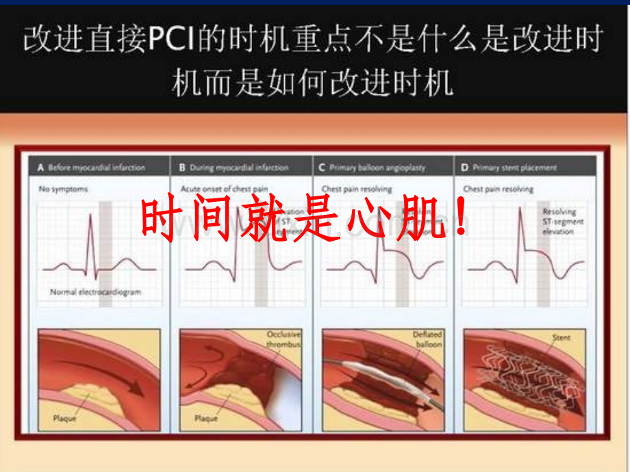 AMI再灌注治疗院前我们能做什么PPT课件.ppt_第3页