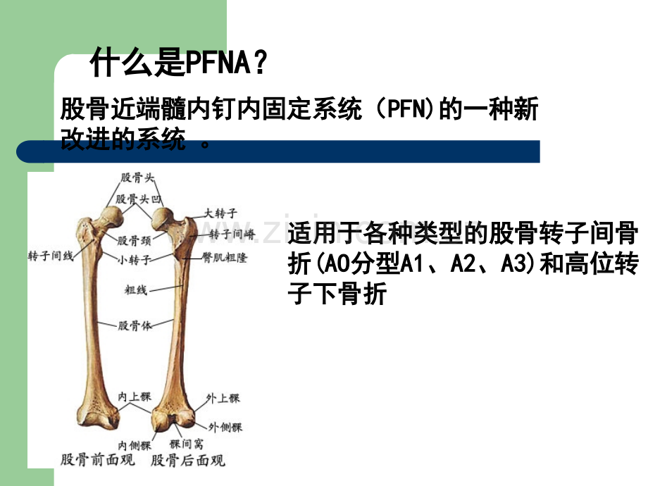 PFNA髓内钉手术配合护理查房ppt课件.ppt_第3页