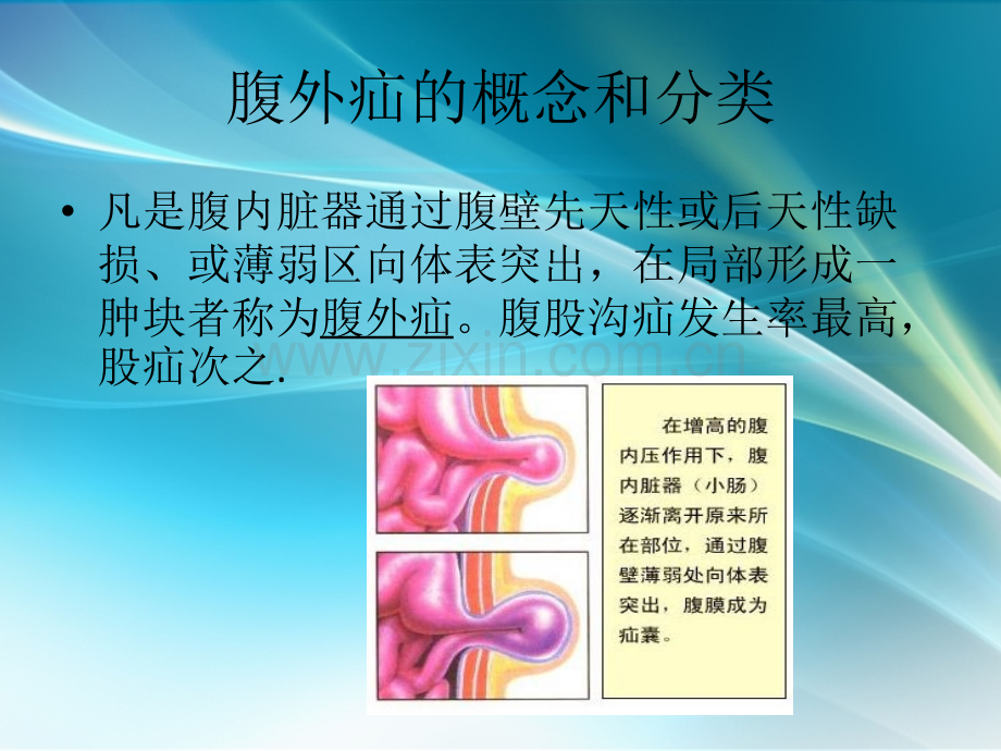 腹股沟疝课件ppt课件.ppt_第3页