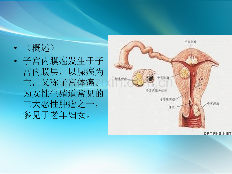 子宫内膜癌手术配合.ppt_第2页