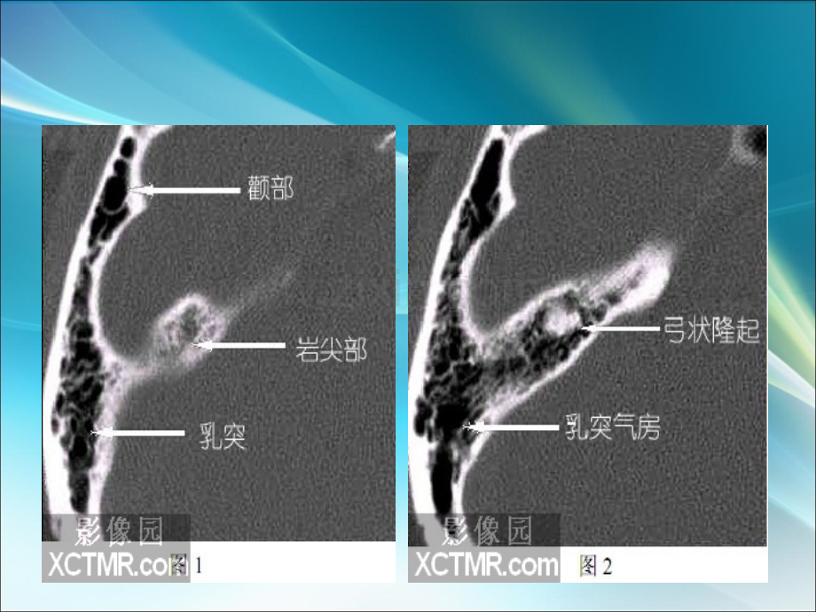 耳部最详细CT解剖ppt课件.ppt_第2页