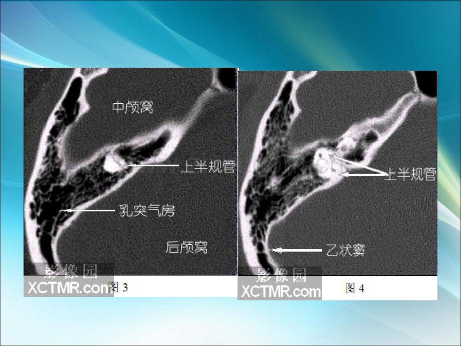 耳部最详细CT解剖ppt课件.ppt_第3页