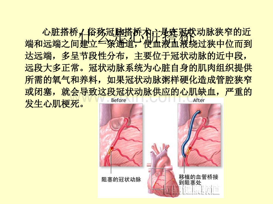 搭桥术后护理查房.ppt_第2页