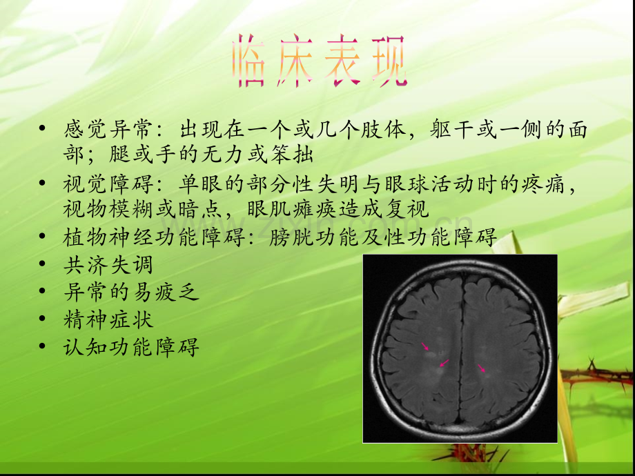 多发性硬化症ppt课件.ppt_第3页