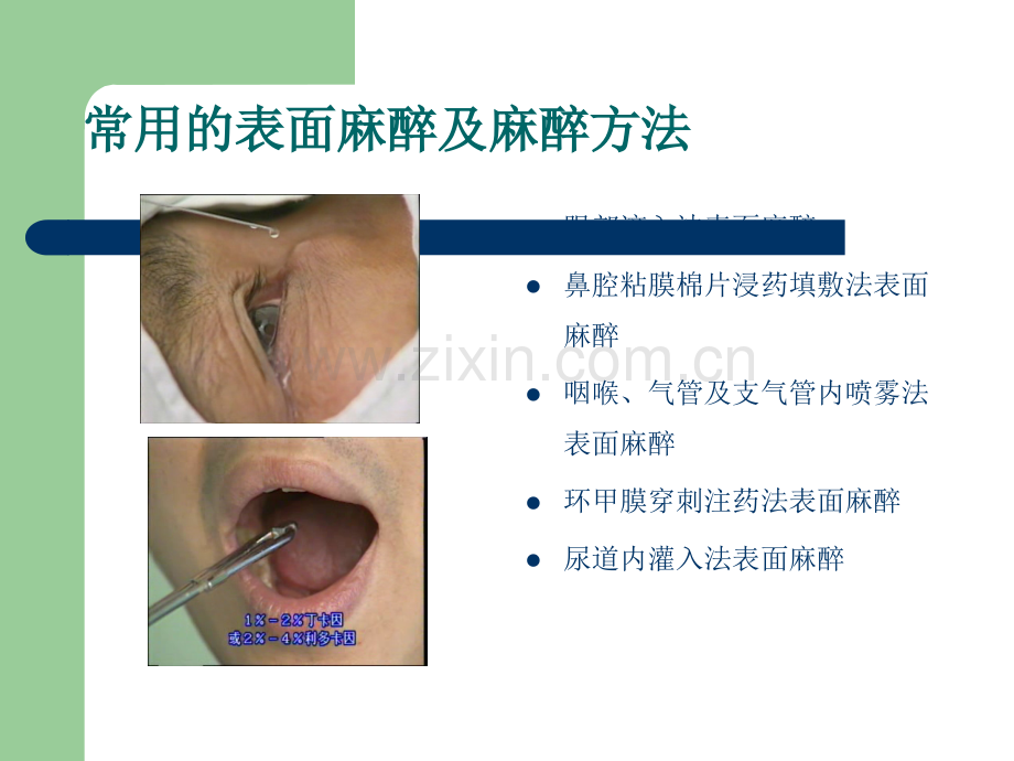 常用局部麻醉方法.ppt_第3页