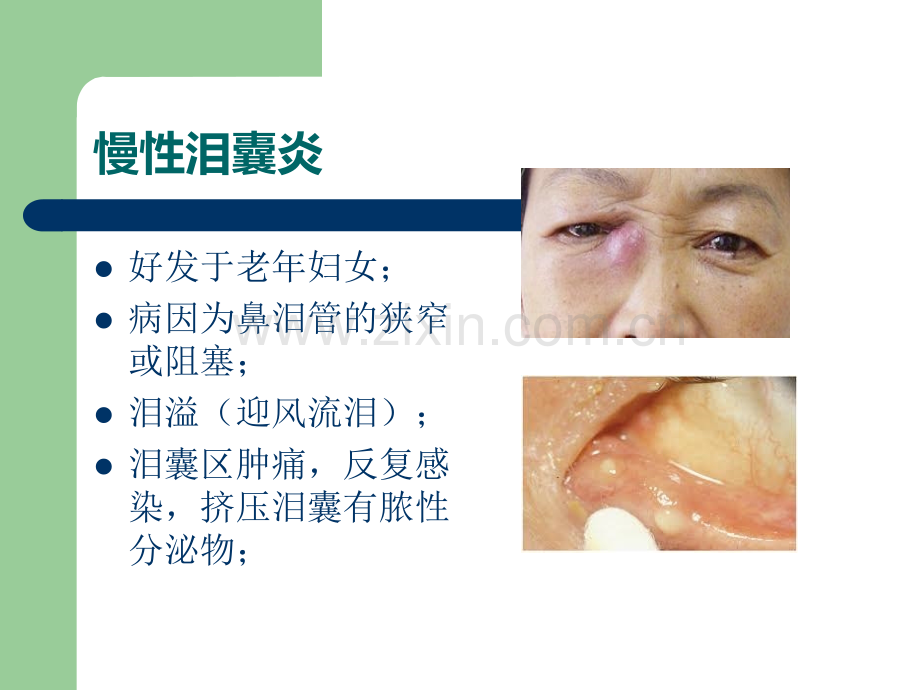 鼻内镜鼻腔泪囊吻合术ppt课件.ppt_第3页