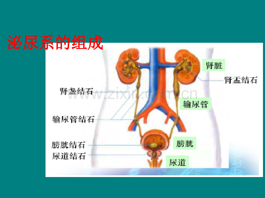 泌尿系结石的护理pptppt课件.ppt_第2页