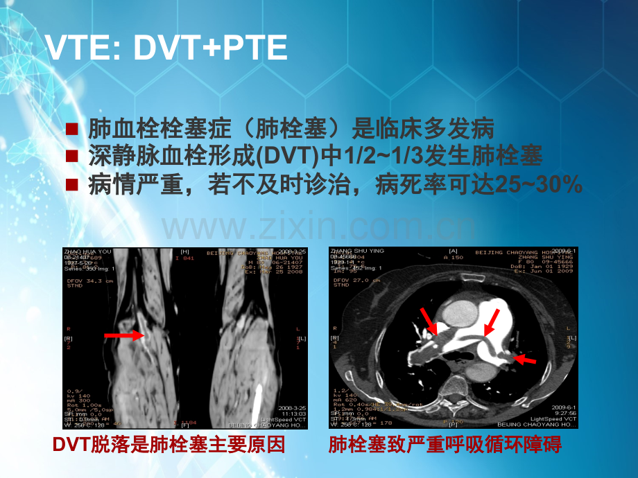 恶性肿瘤与静脉血栓栓塞症ppt课件.ppt_第2页