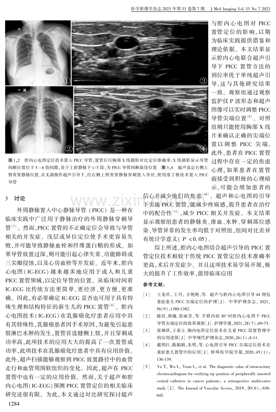 腔内心电图联合超声在乳腺癌化疗患者PICC置管中的临床应用.pdf_第3页