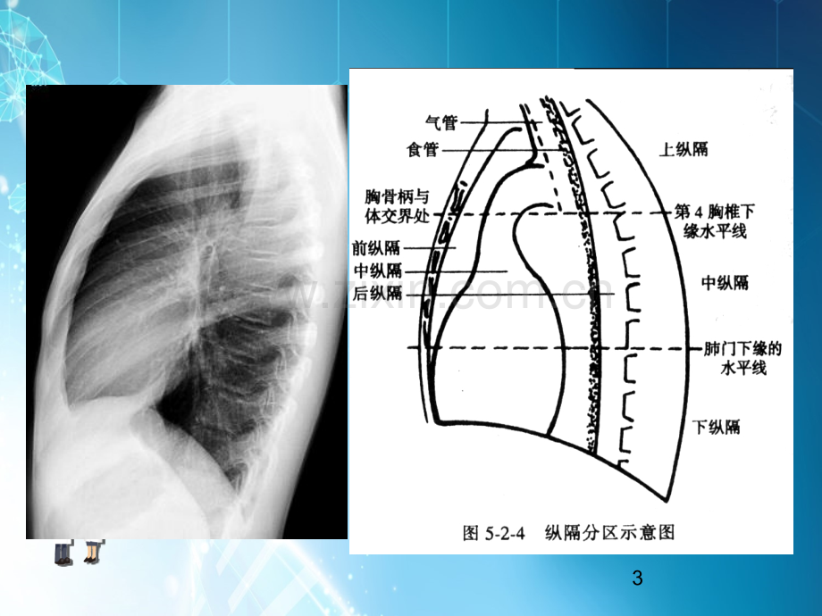 第八章-纵隔疾病ppt课件.ppt_第3页