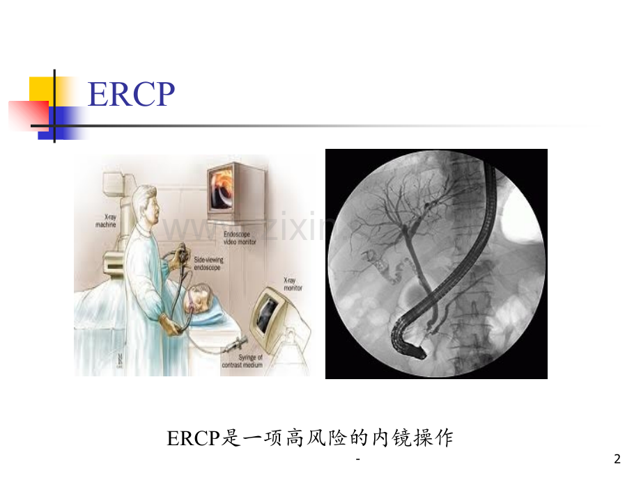 ERCP围手术期处理PPT课件.ppt_第2页