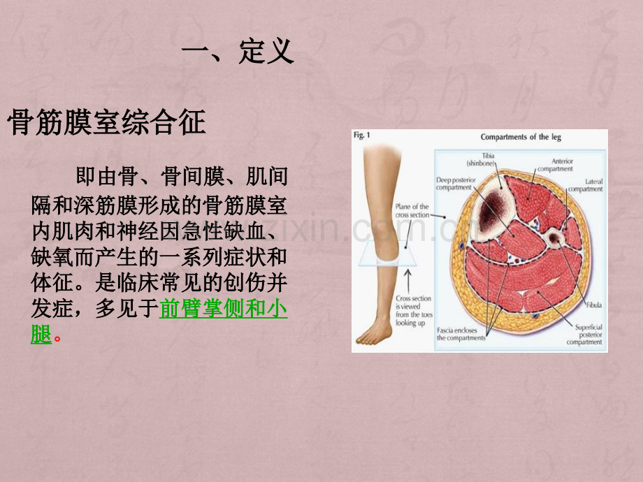 骨筋膜室综合征的护理ppt课件.pptx_第3页