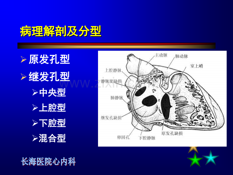 房间隔缺损介入治疗PPT课件.ppt_第2页