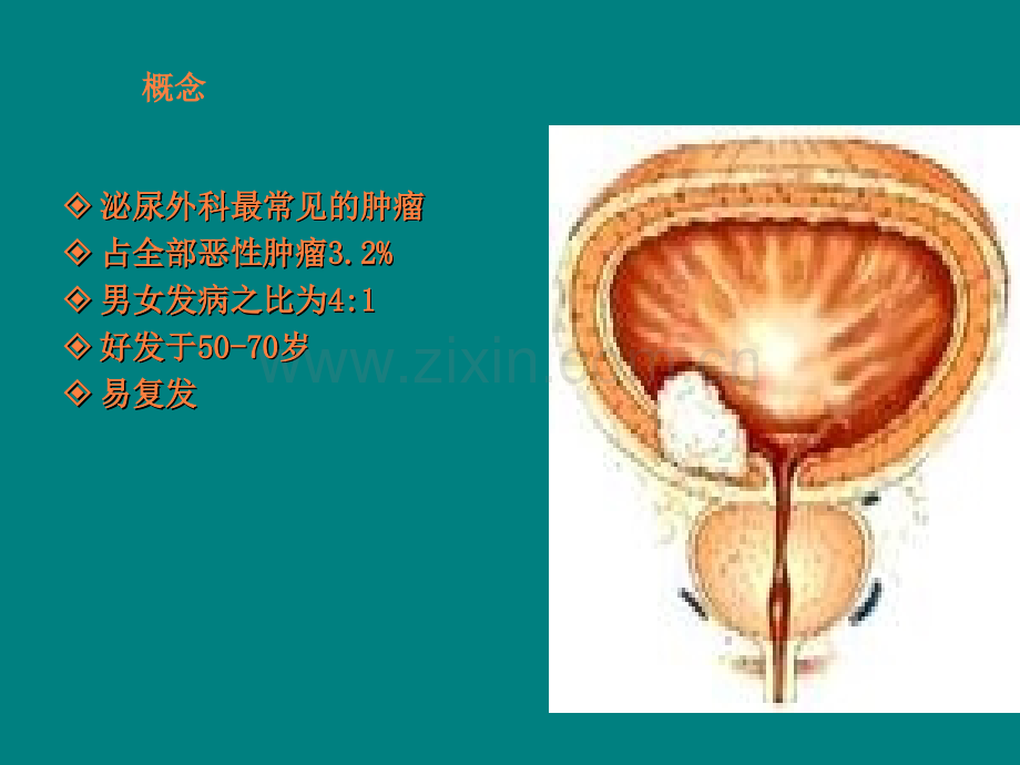 膀胱灌注ppt课件.ppt_第3页