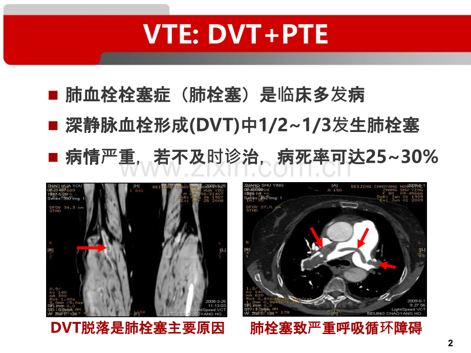 恶性肿瘤和静脉血栓栓塞症PPT课件.ppt_第2页