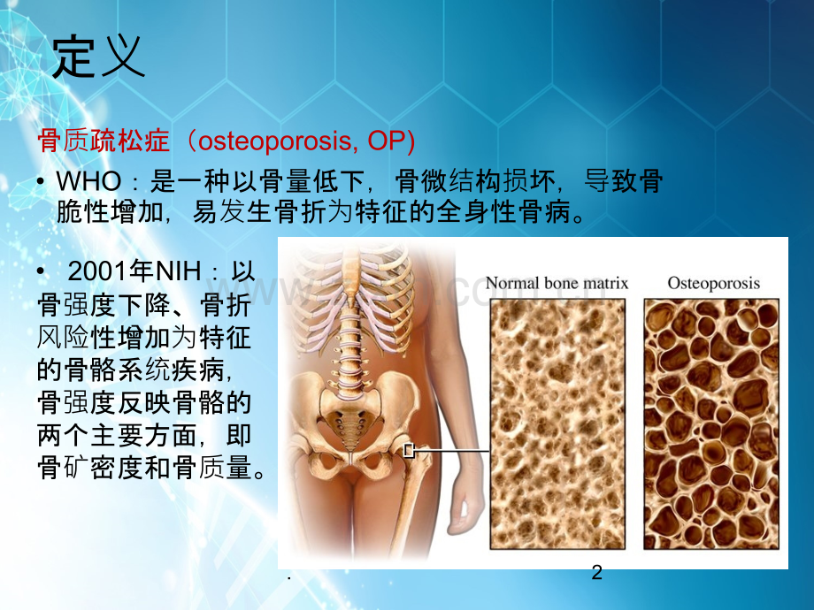 原发性骨质疏松症诊治指南ppt课件.ppt_第2页