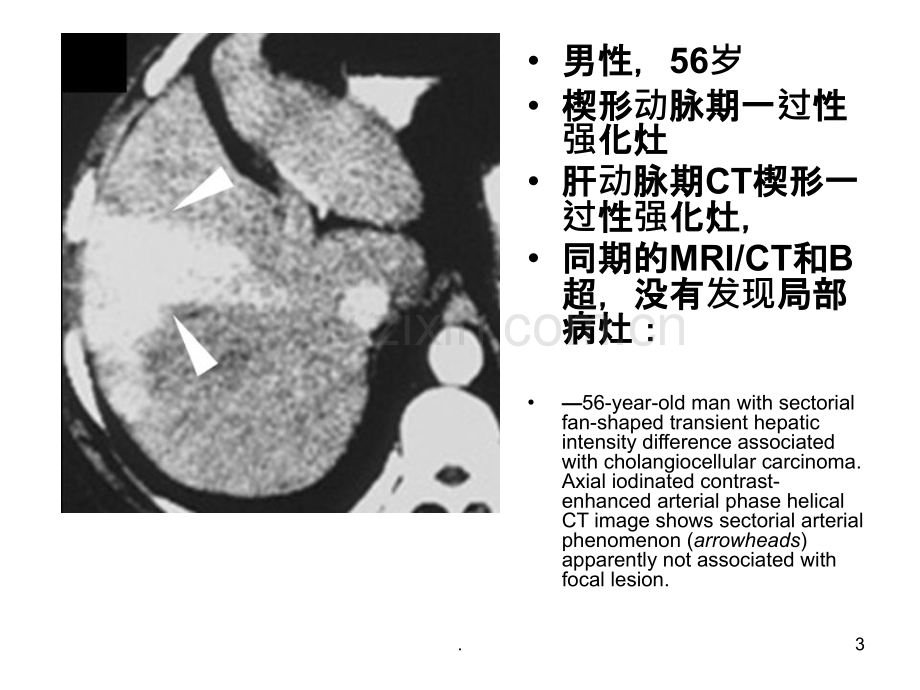 肝脏动脉期一过性强化灶ppt课件.ppt_第3页