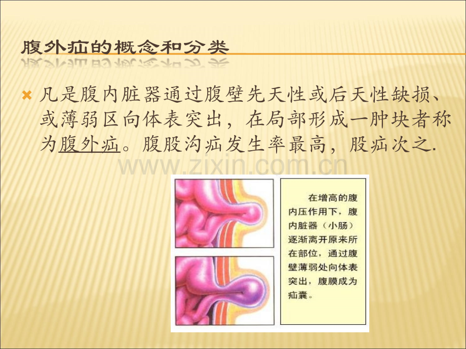 腹股沟疝(课件).ppt_第3页