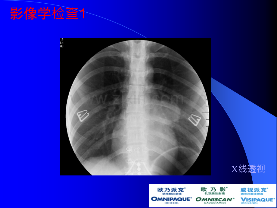 肺硬化性血管瘤ppt课件.ppt_第3页