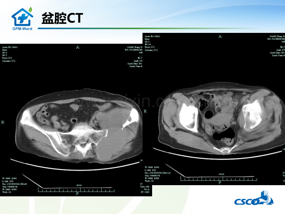 GM癌痛病例ppt课件.ppt_第3页