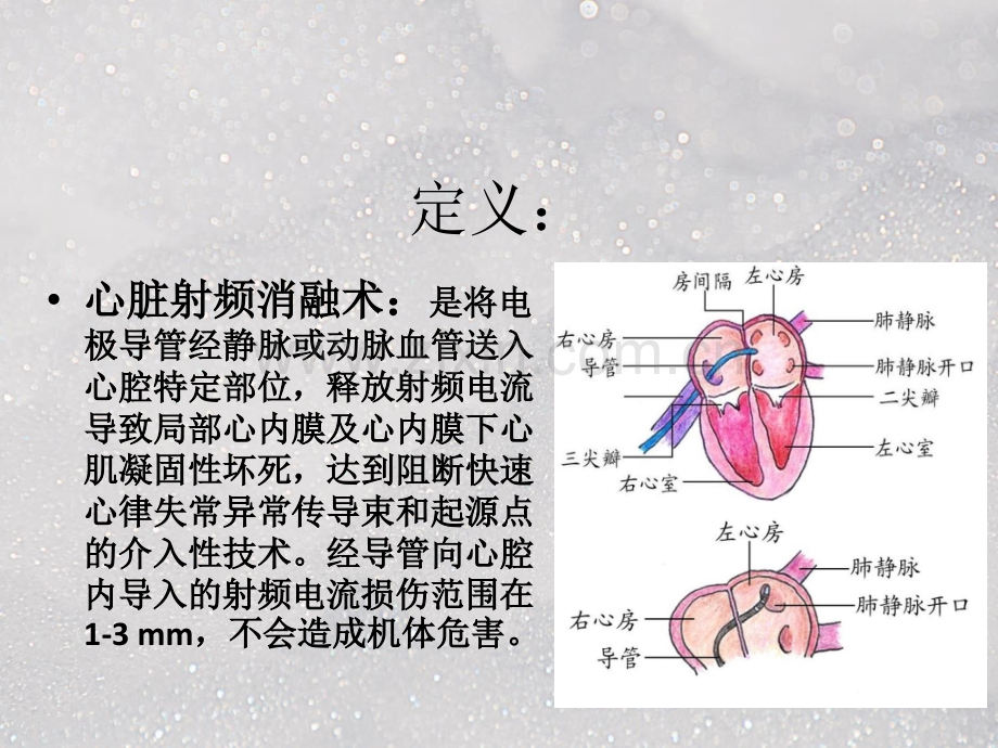 射频消融术术后护理ppt课件.pptx_第2页