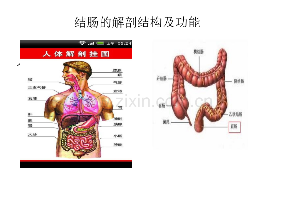 溃疡性结肠炎ppt课件.pptx_第3页