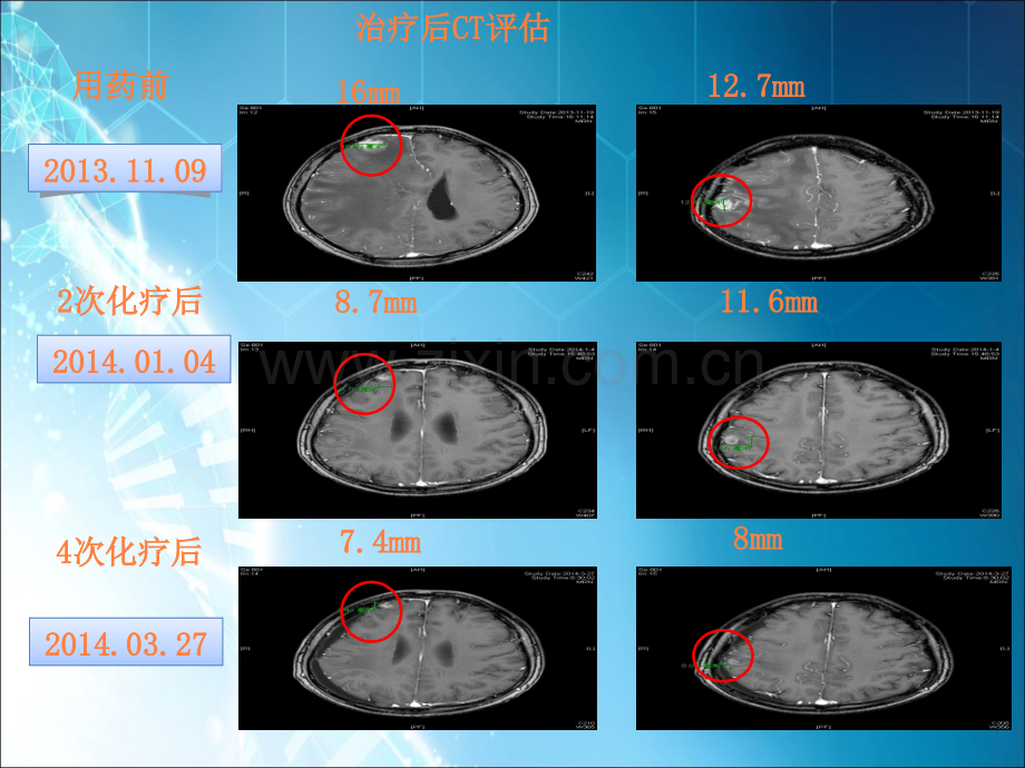 安维汀-肺癌脑转移患者分子靶向治疗的疗效和安全性ppt课件.ppt_第3页