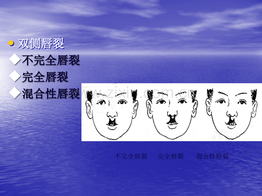 先天性唇裂与腭裂.ppt_第3页