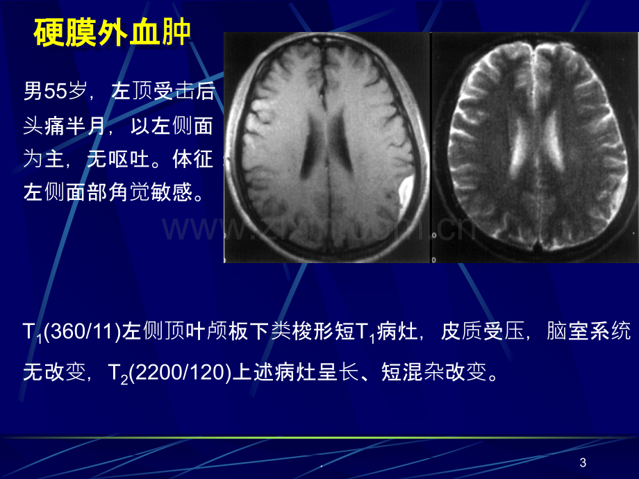 MRI图像-脑ppt课件.ppt_第3页