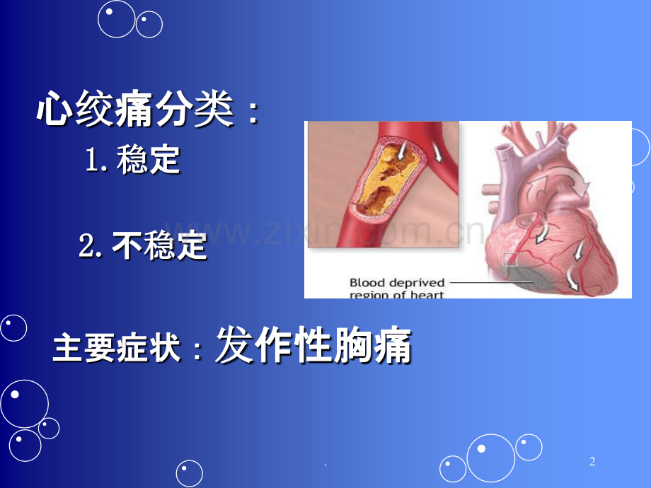 心绞痛健康教育PPT课件.ppt_第2页