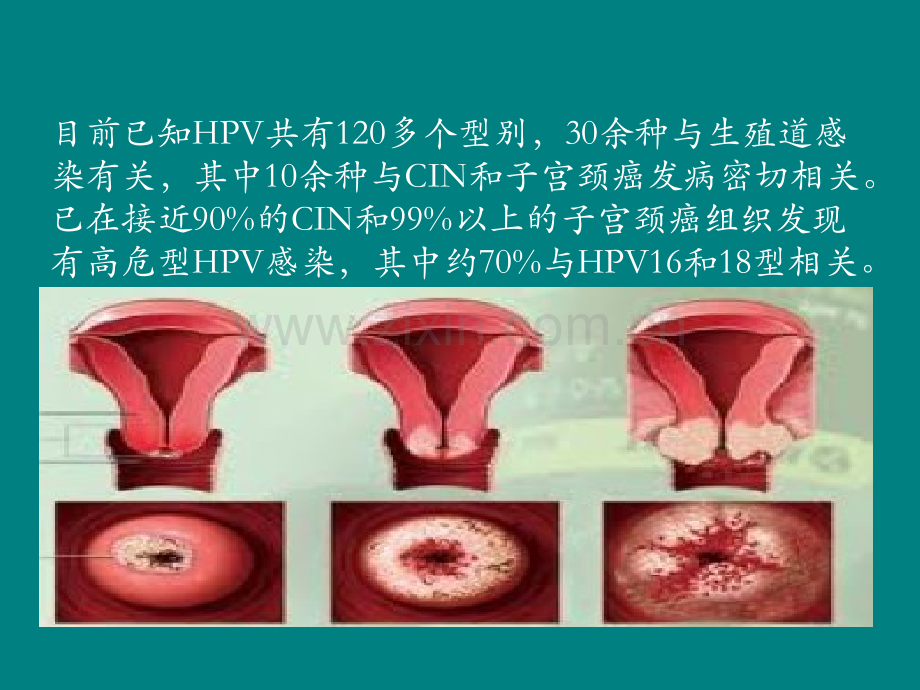 宫颈癌疫苗与HPVppt课件.pptx_第3页