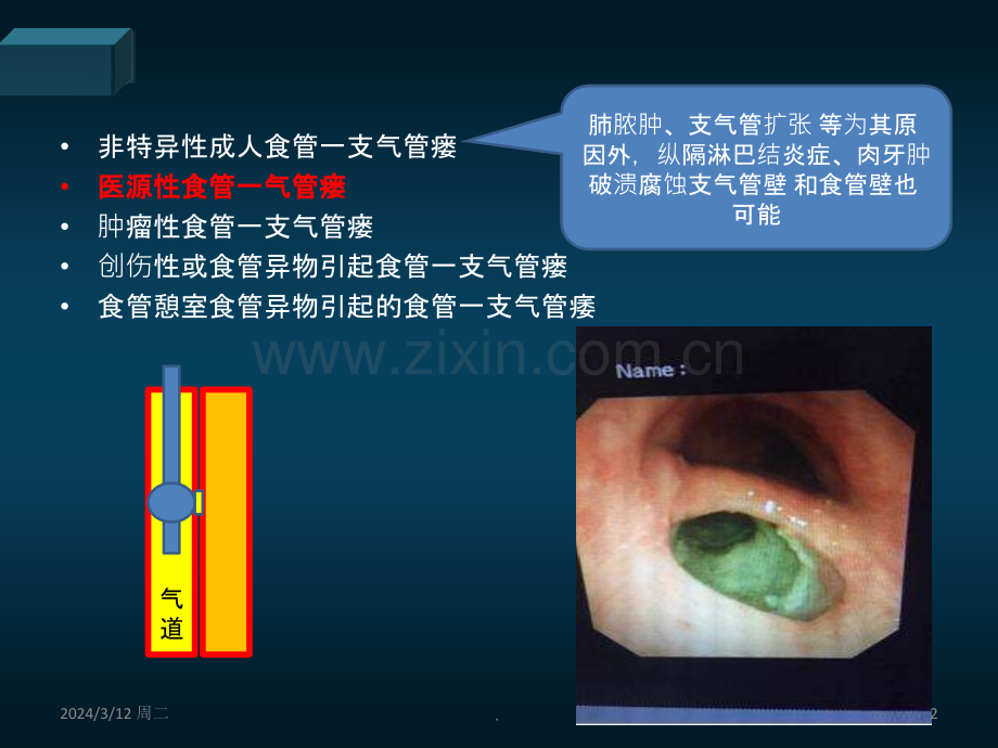 医源性气管食管瘘的防治PPT课件.ppt_第2页