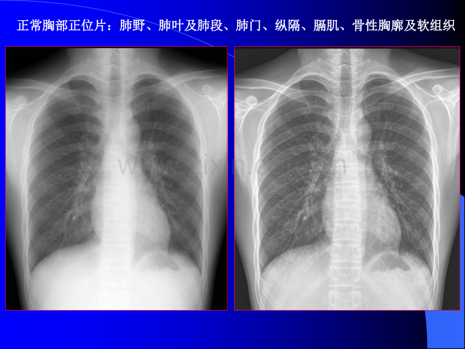 常见的X线和CT诊断ppt课件.ppt_第3页