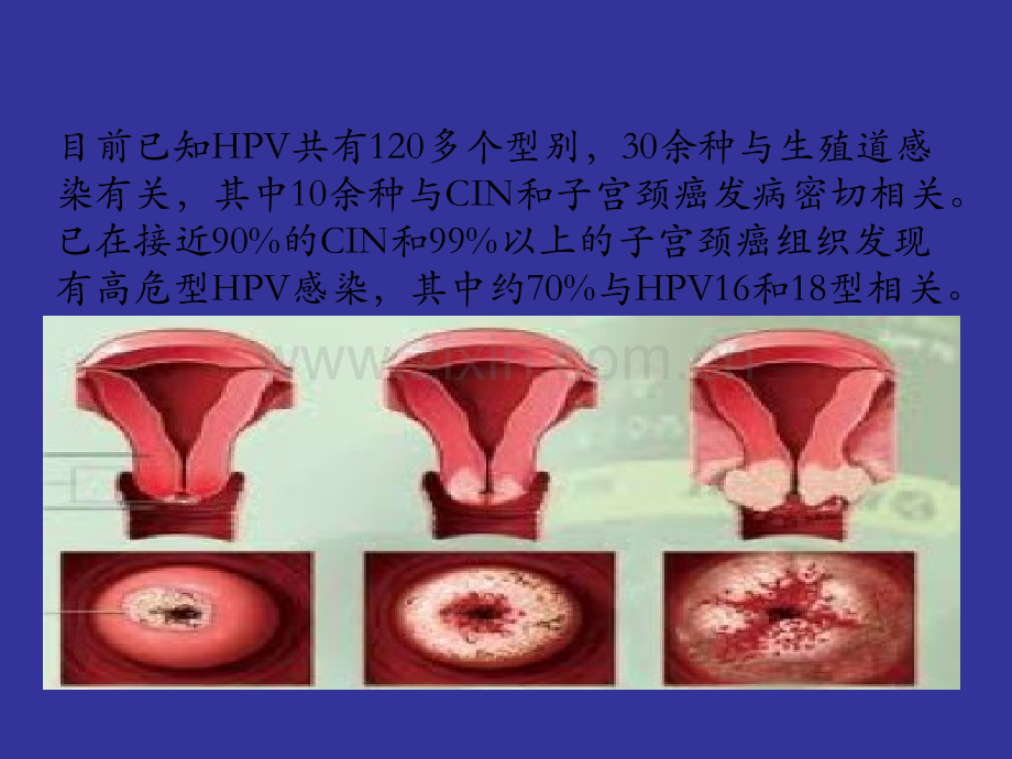 宫颈癌疫苗与HVppt课件.pptx_第3页