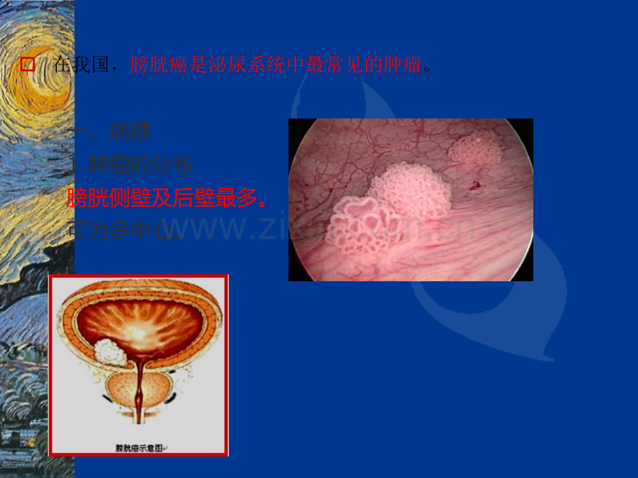 膀胱癌鞘膜积液ppt课件.ppt_第3页