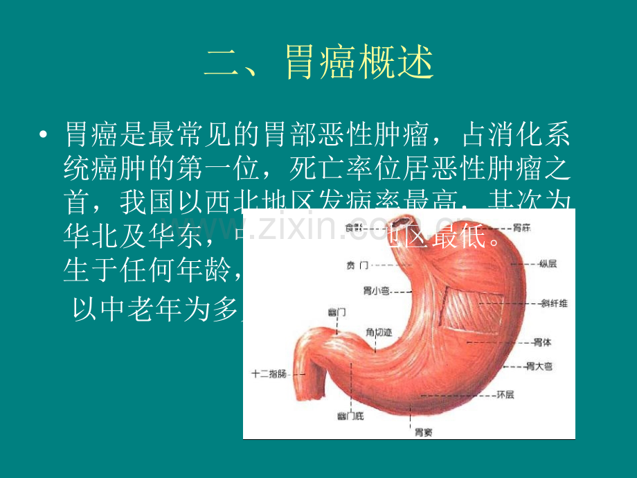 胃癌术后护理查房(1).ppt_第3页