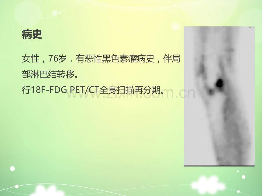 膝关节骨性关节炎影像学病例ppt课件.pptx_第2页