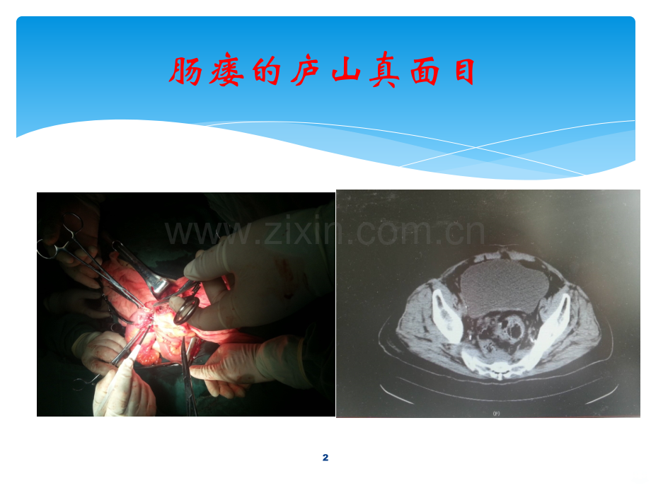 肠瘘治疗PPT课件.ppt_第2页