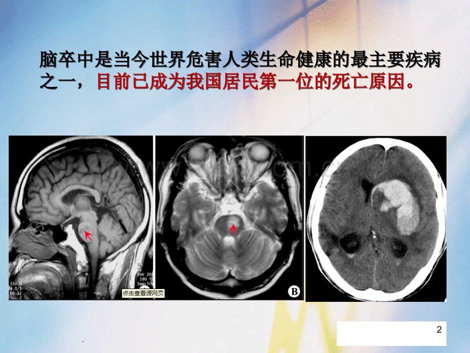 病例分享——卒中相关性肺炎ppt课件.ppt_第2页