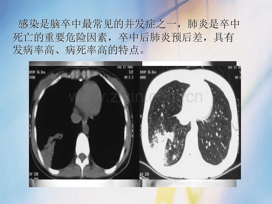 病例分享——卒中相关性肺炎ppt课件.ppt_第3页