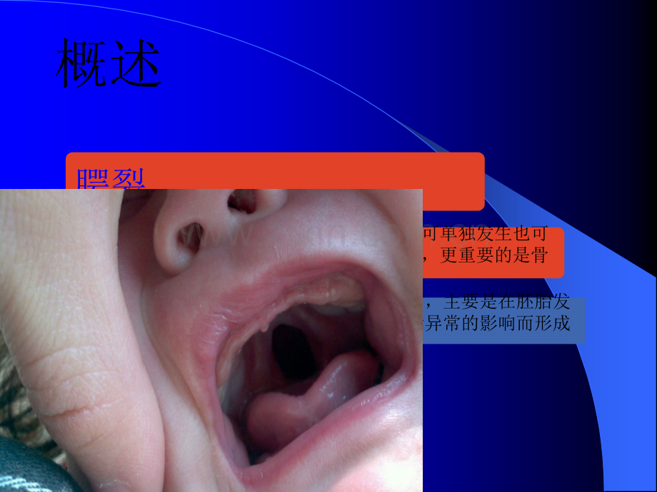 腭裂手术患儿的护理ppt课件.ppt_第3页