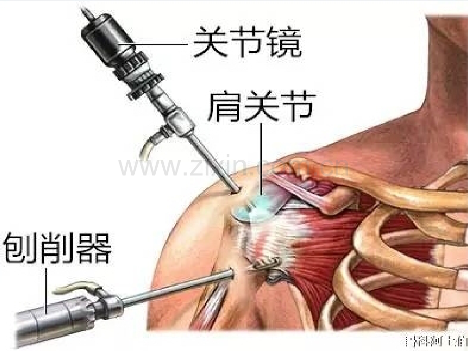 肩关节镜术后护理ppt课件.pptx_第3页