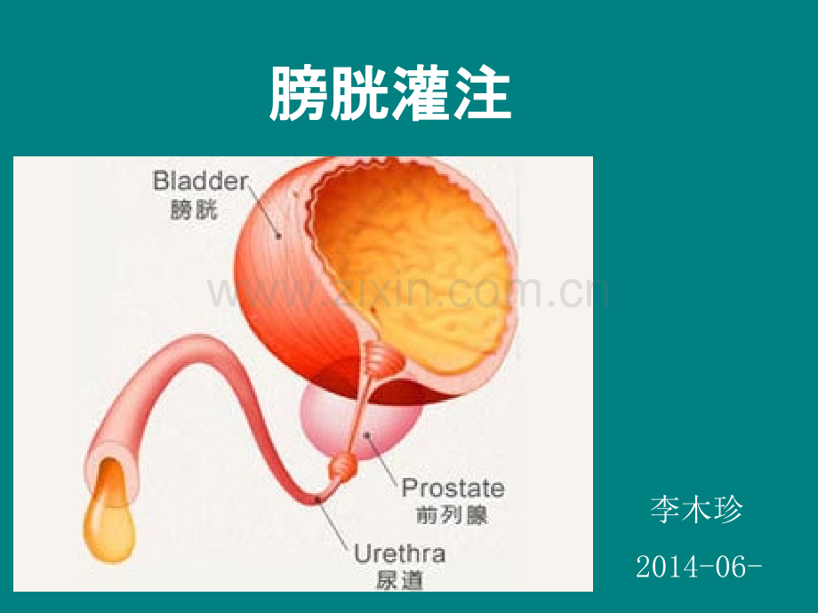 膀胱灌注术ppt课件.ppt_第1页