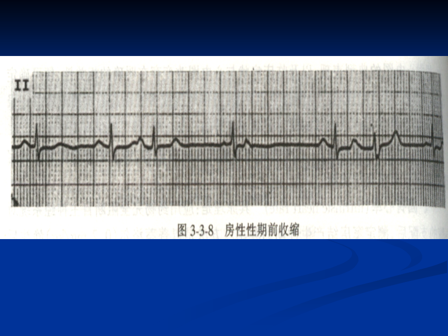 房性心律失常.ppt_第3页