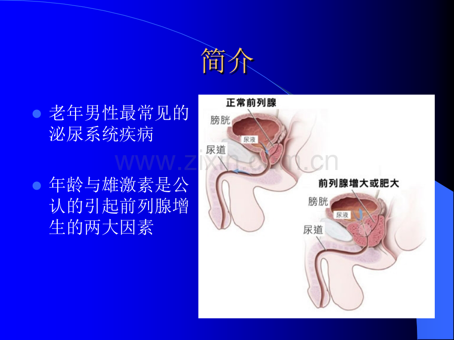 前列腺增生教学查房ppt课件.pptx_第2页