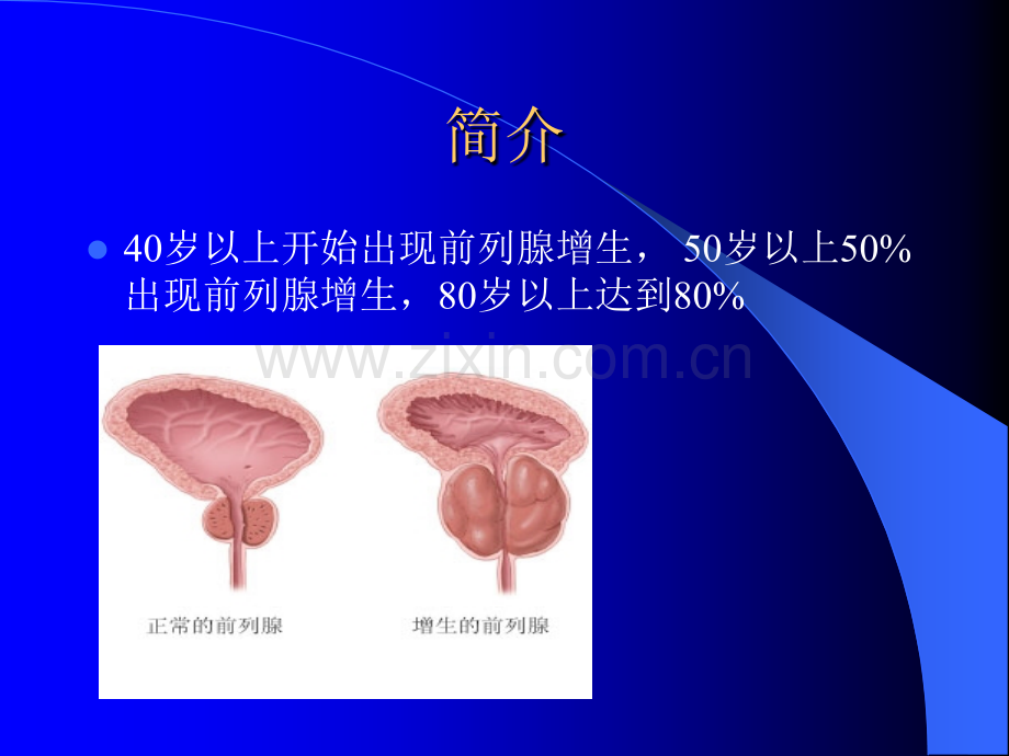 前列腺增生教学查房ppt课件.pptx_第3页