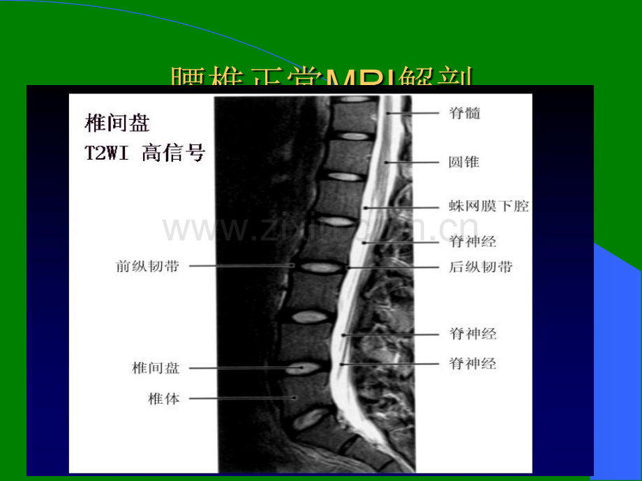 腰椎间盘的MRI诊断.ppt_第2页