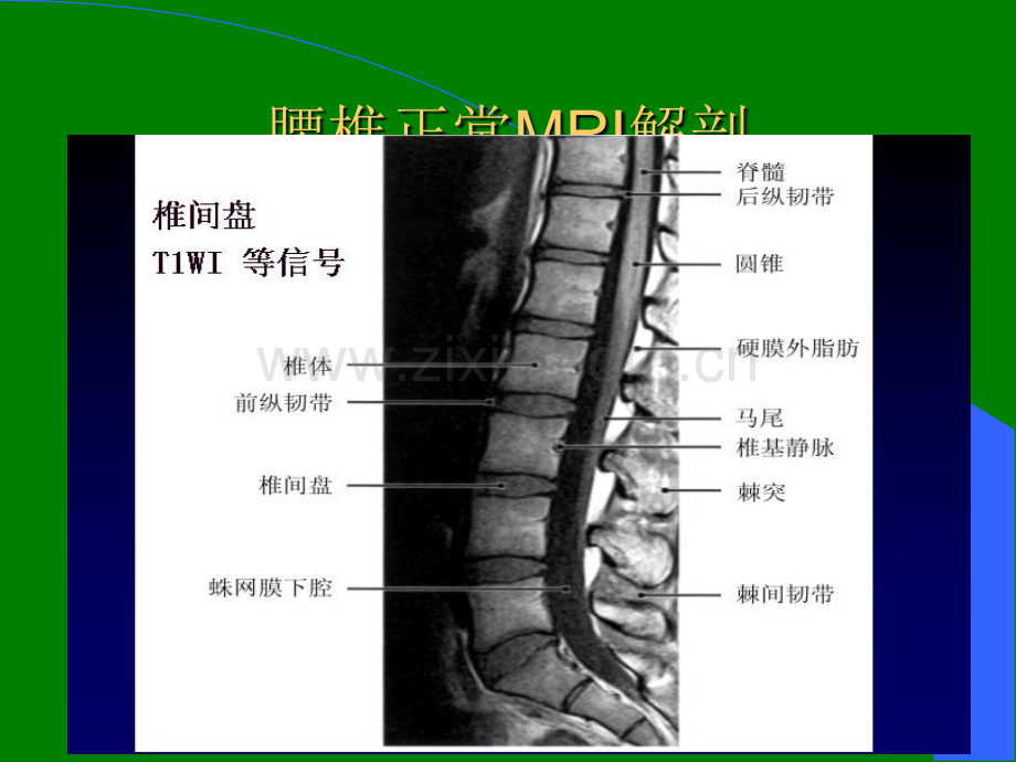 腰椎间盘的MRI诊断.ppt_第3页