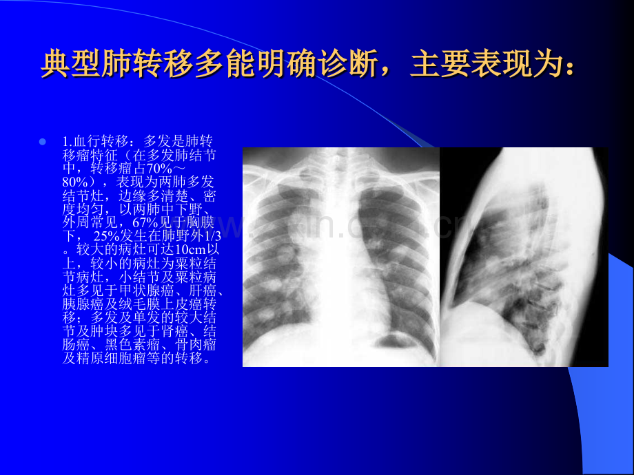 肺部转移瘤的影像诊断ppt课件.ppt_第2页