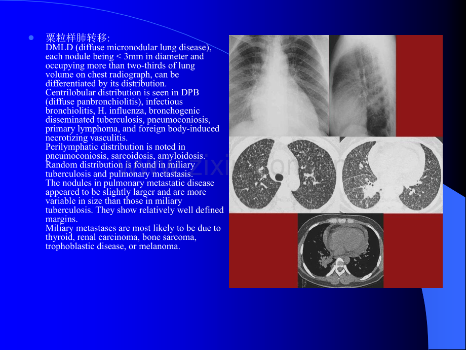 肺部转移瘤的影像诊断ppt课件.ppt_第3页